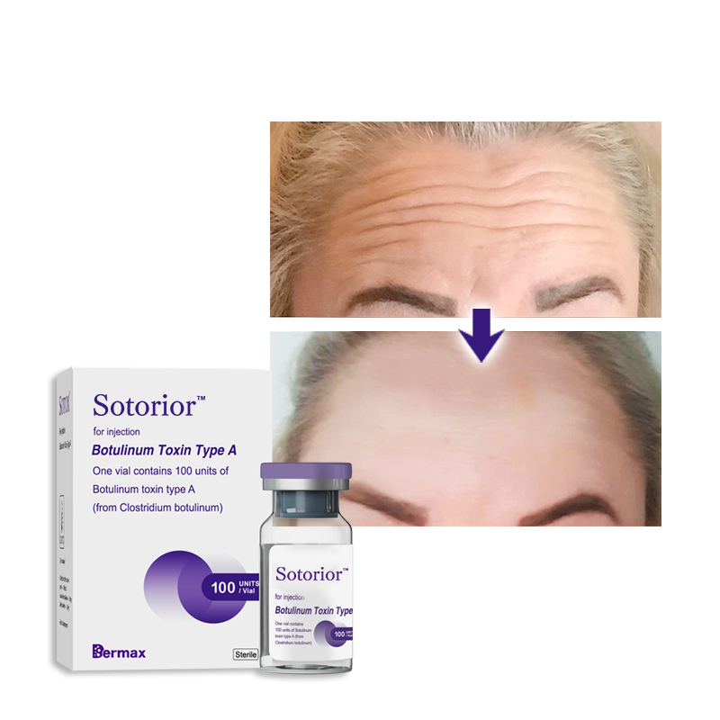 Sotorior® Botulinum Injections To Remove Wrinkles