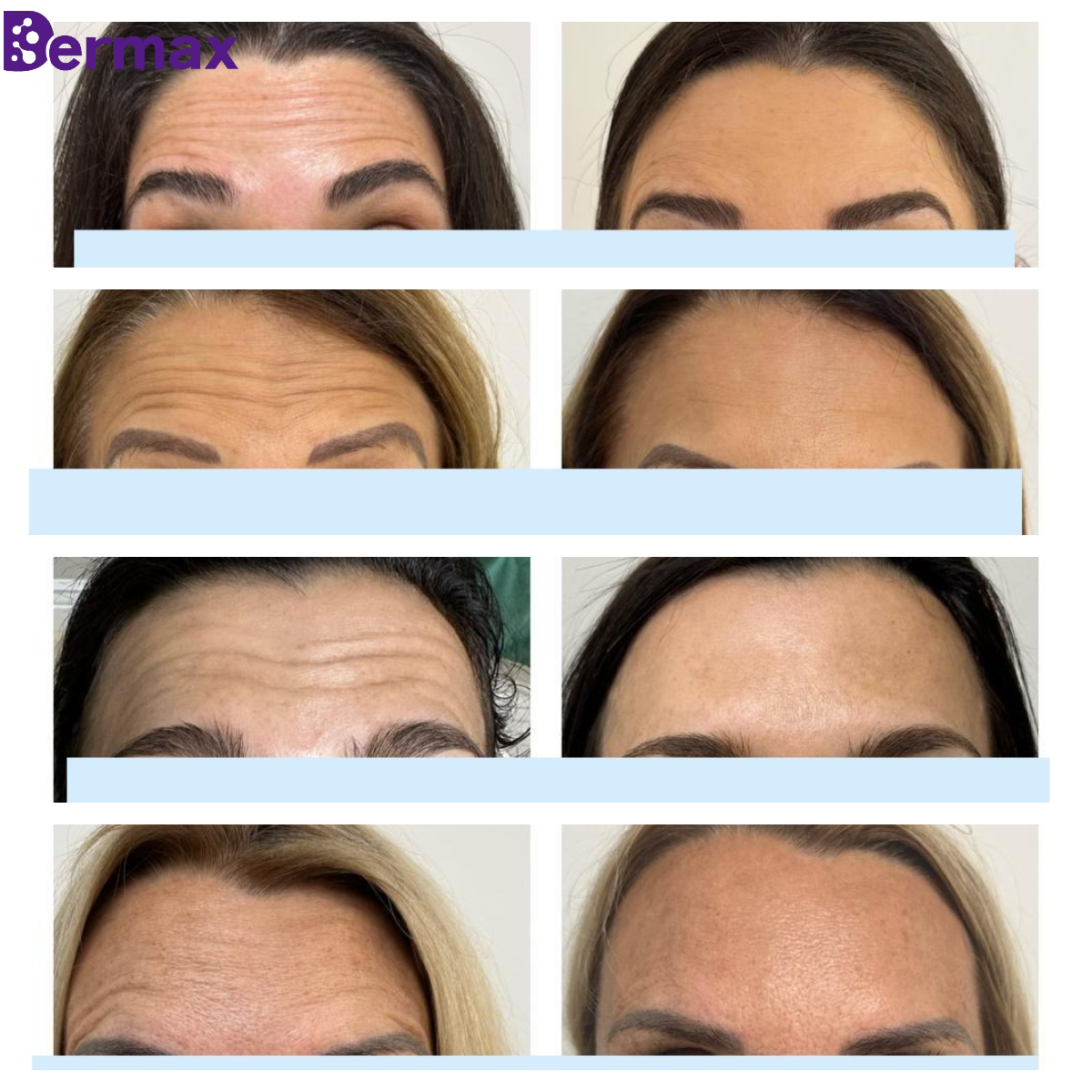 botulinum toxin for frown lines