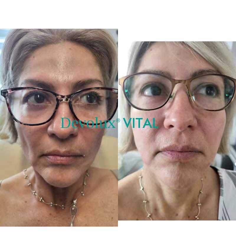 devolux cheeks before and after photos