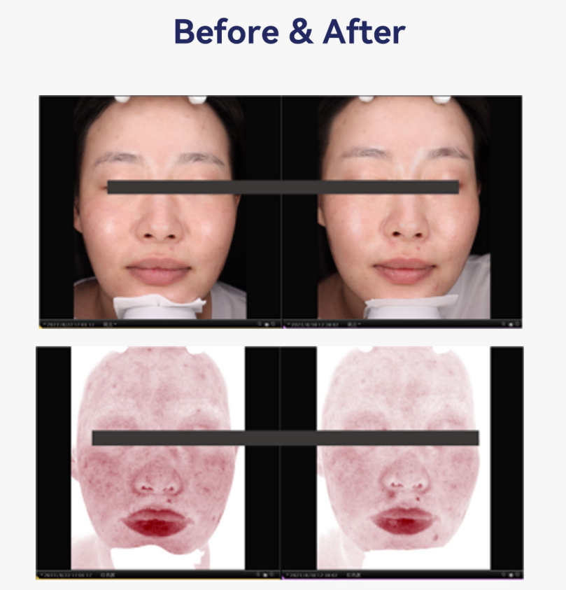 mesocel PDRN before after