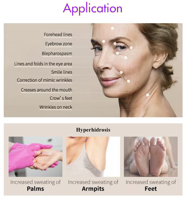 botulinum toxin type a treatment areas