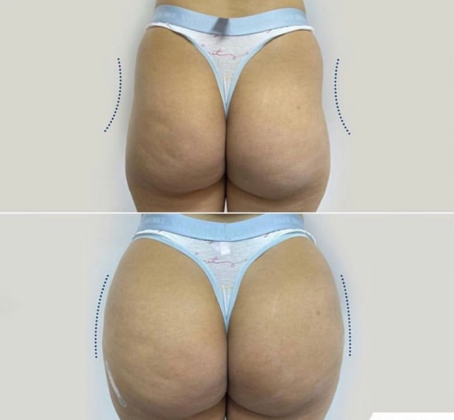 plla buttock injection before and after pictures