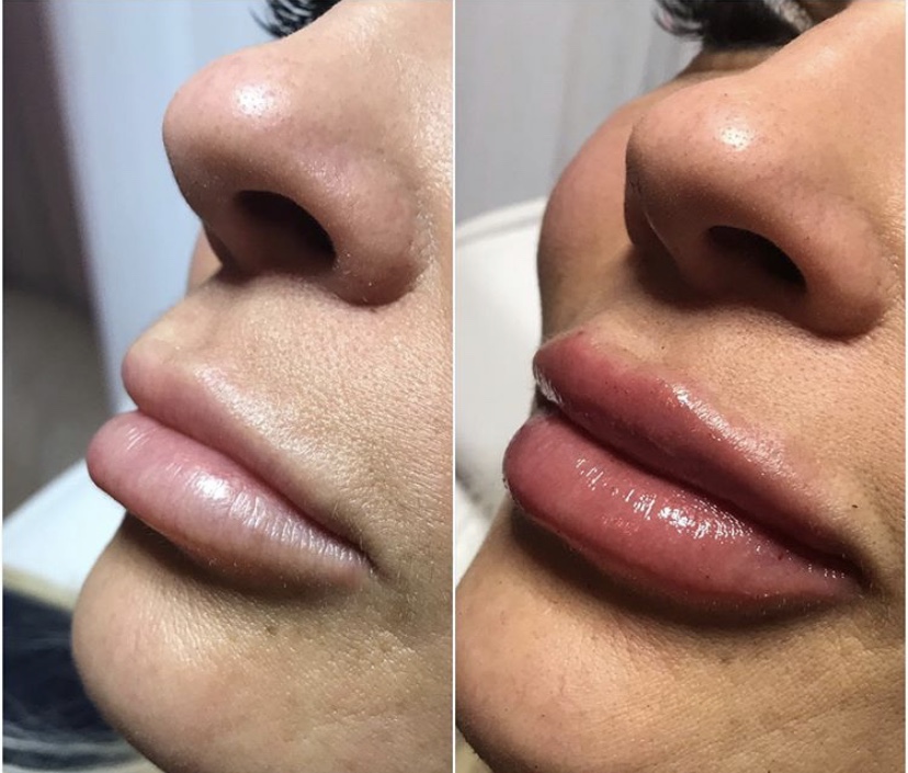 hyaluronic lip filler before and after photos