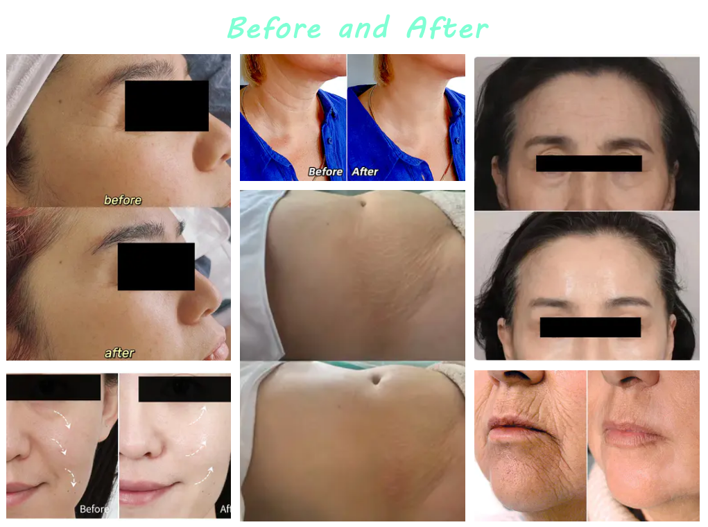 poly-l-lactic acid filler before and after