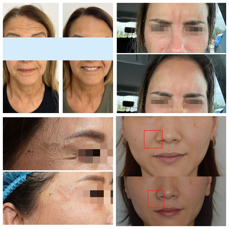 botulinum toxin before and after