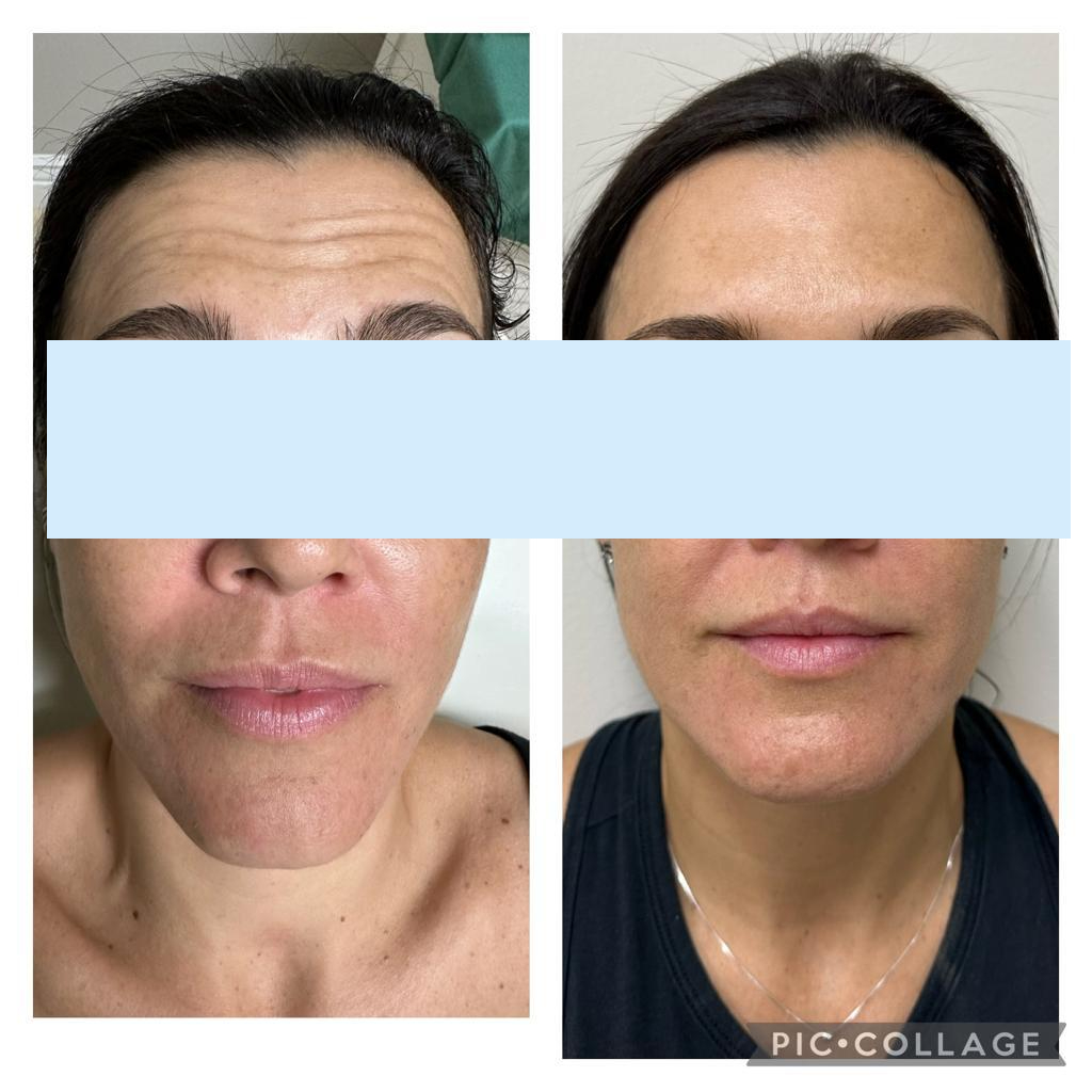 Botulinum Toxin For Wrinkles