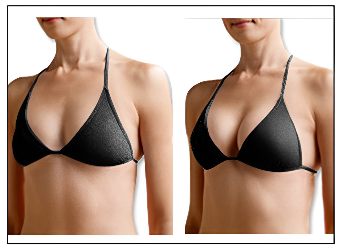 plla breast enlargement before and after