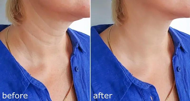 plla for neck rejuvenation