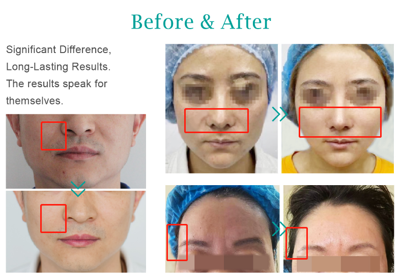 plla ha dermal filler injection