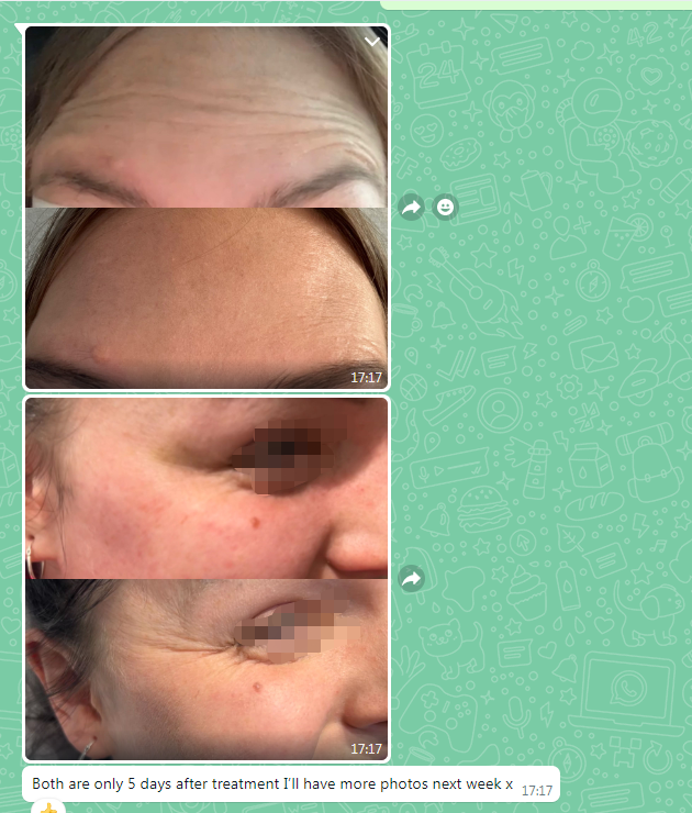 botulinum toxin for optimal results