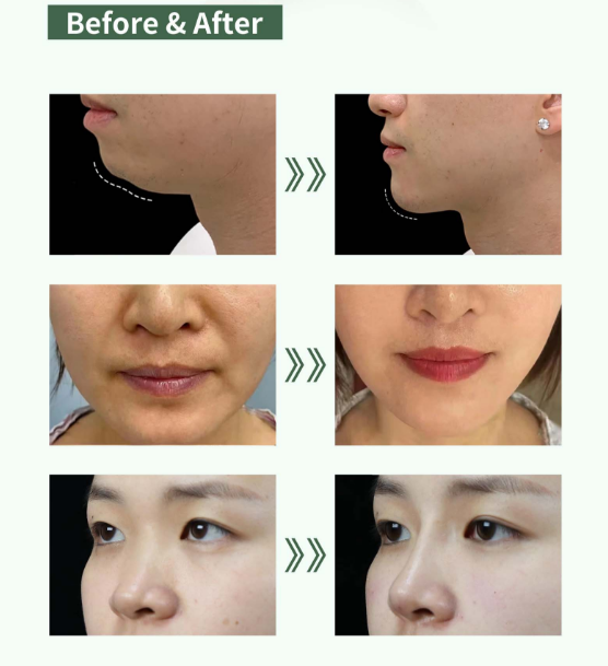 PrimeFill® PMMA Filler Before ＆ After