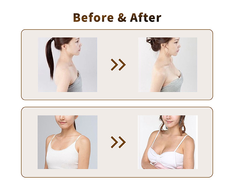 breast fillers before and after