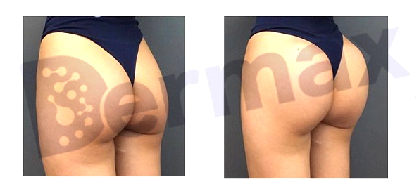 plla buttock injection before and after pictures