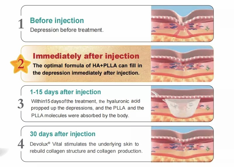 plla ha dermal filler injection