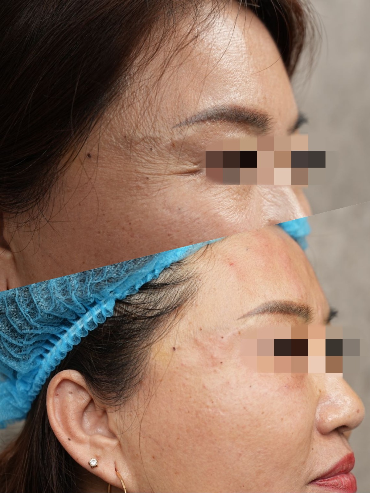 botulinum toxin before and after photo