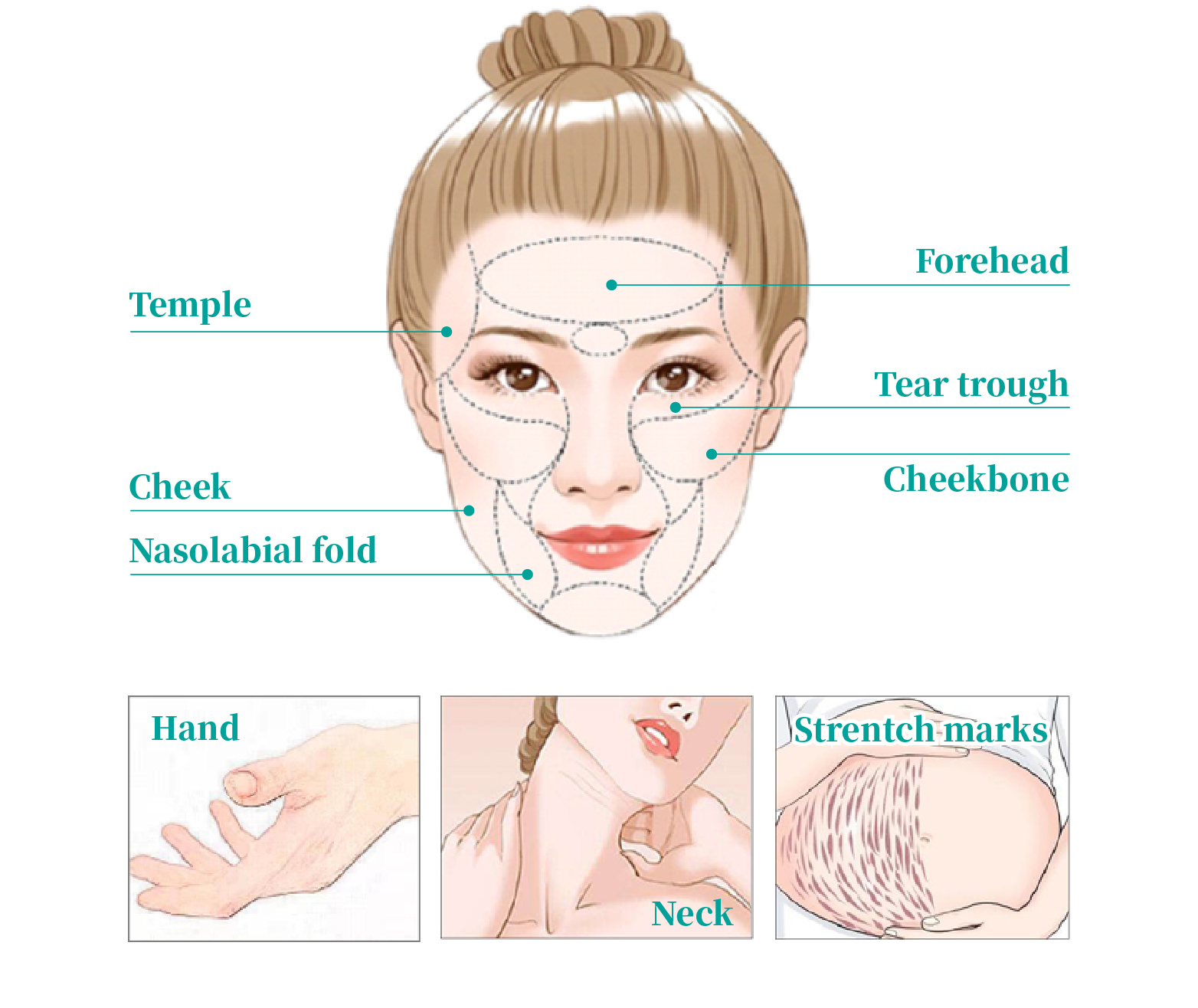 injectable poly l lactic acid