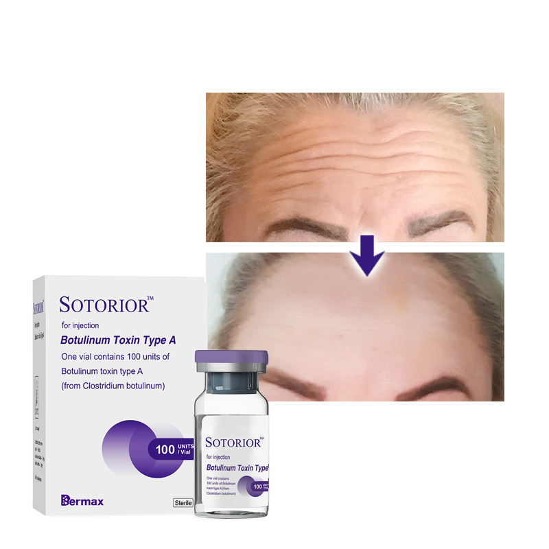 botulinum toxin treatment