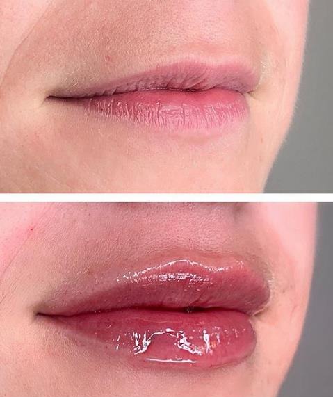 lip filler before and after