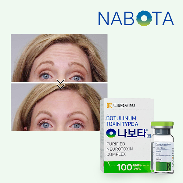 Nabota botulinum toxin type a Price