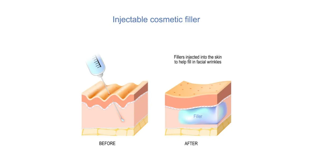 Best Korean Dermal Fillers